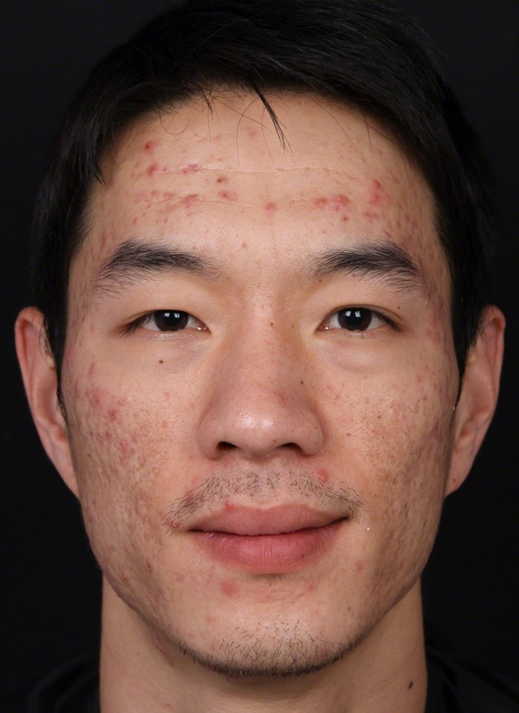 Isolaz Before & After Image