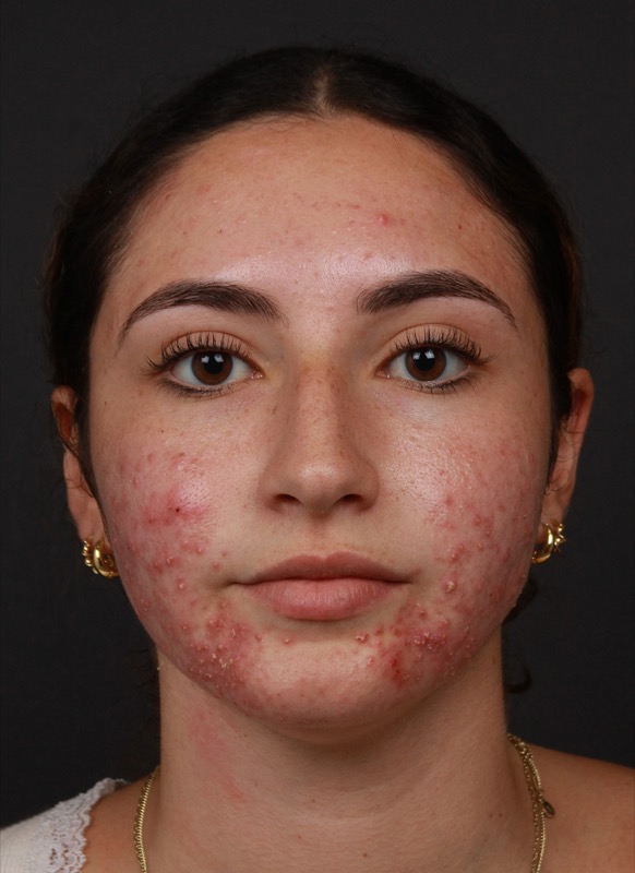 LightStim Before & After Image