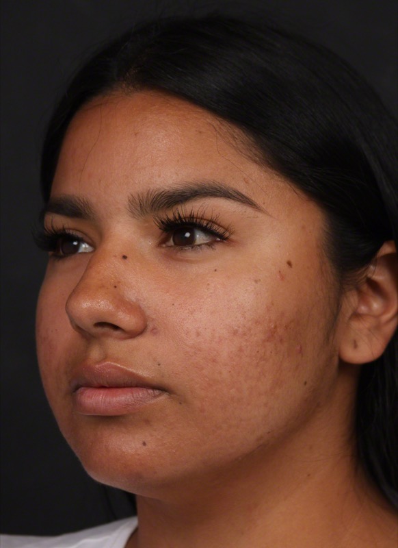 Photodynamic Therapy Before & After Image