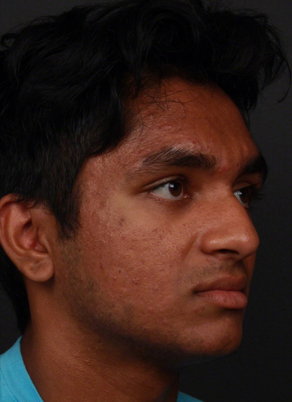 Photodynamic Therapy Before & After Image