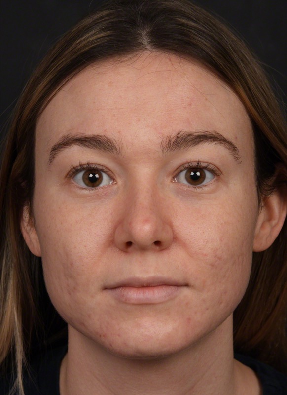 Photodynamic Therapy Before & After Image