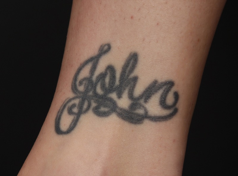 PicoWay Before & After Image