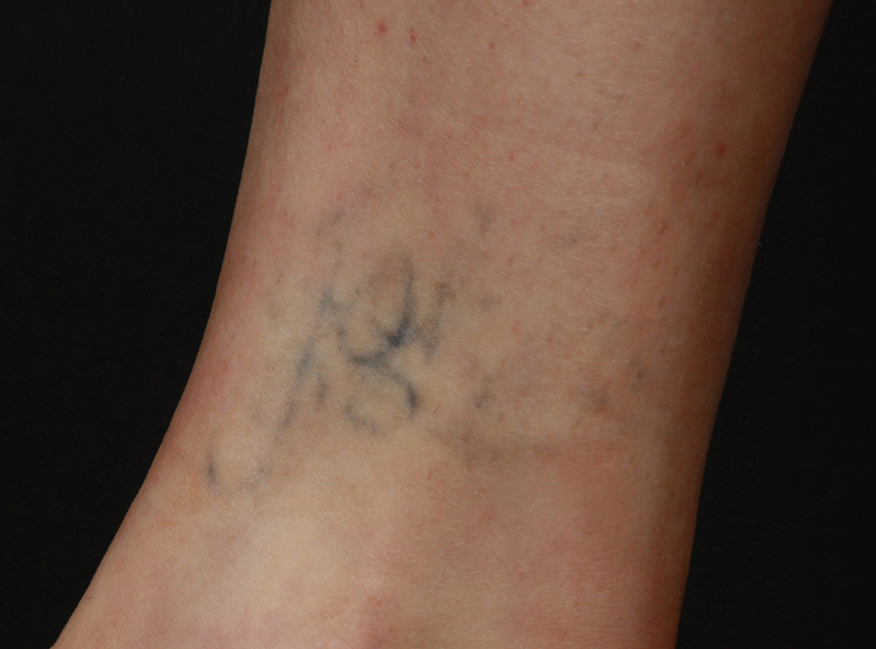 PicoWay Before & After Image