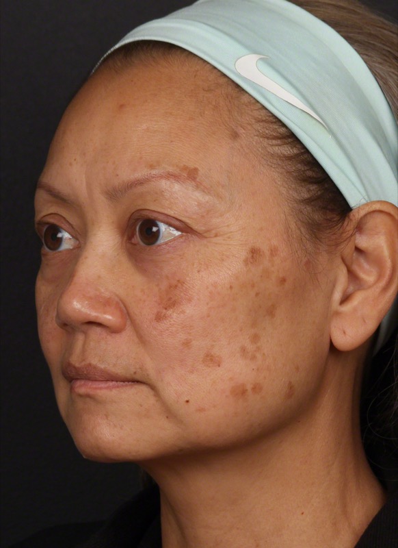 PicoWay Before & After Image