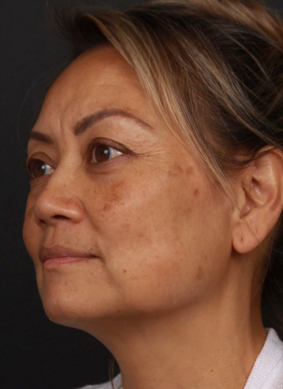 PicoWay Before & After Image