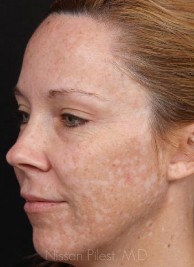 Pigmentation Before & After Image