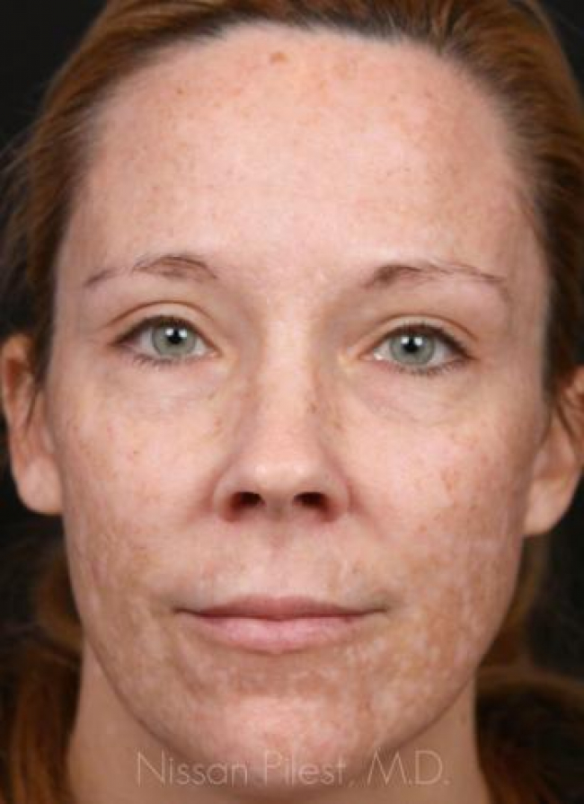 Pigmentation Before & After Image