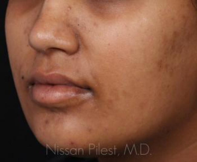 Pigmentation Before & After Image