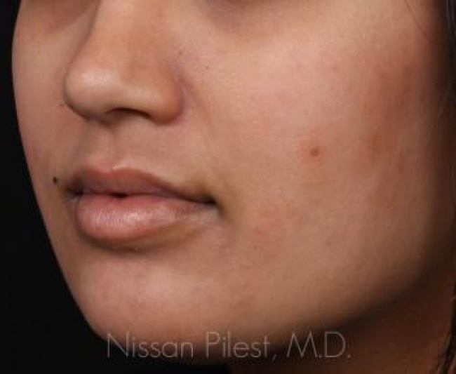 Pigmentation Before & After Image