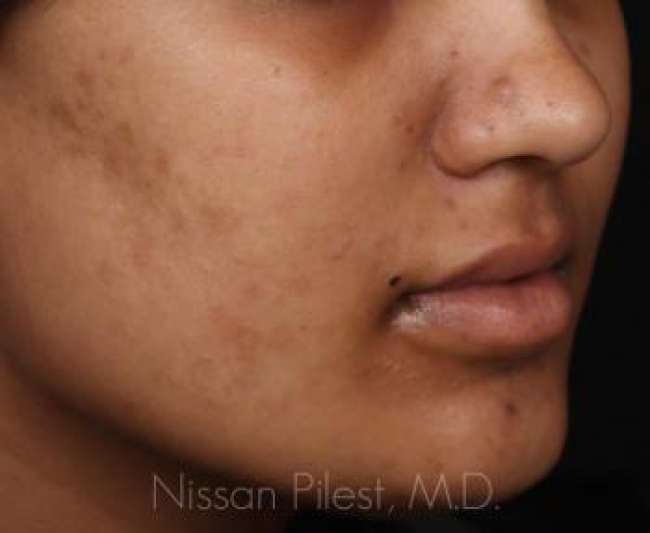 Pigmentation Before & After Image