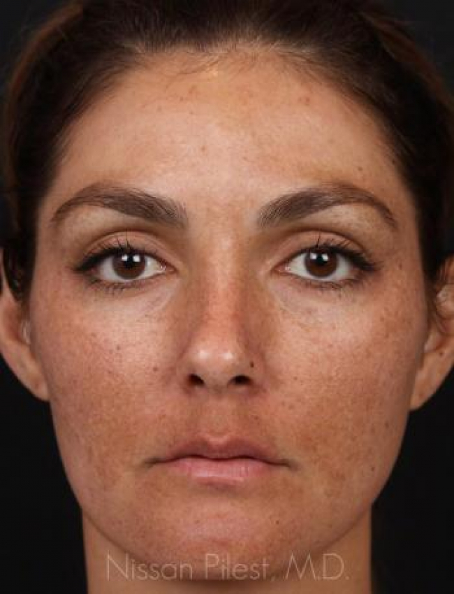 Pigmentation Before & After Image