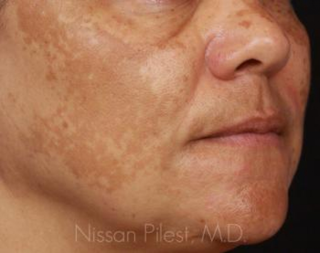 Pigmentation Before & After Image