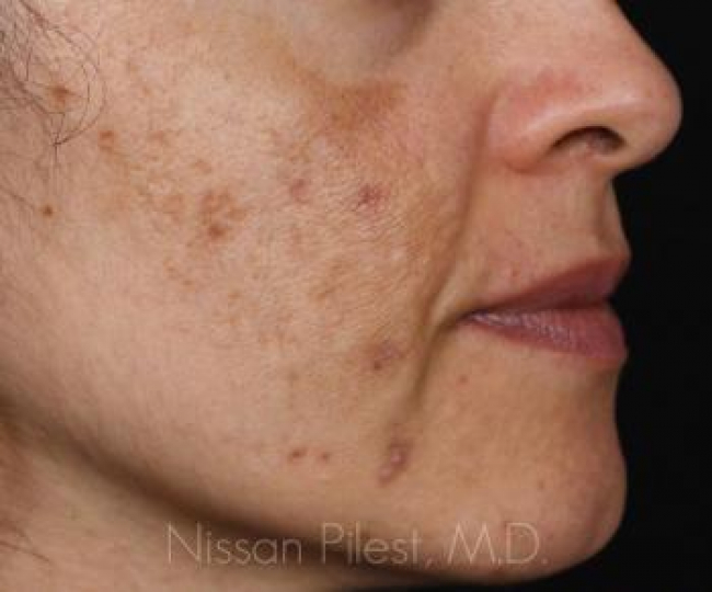 Pigmentation Before & After Image