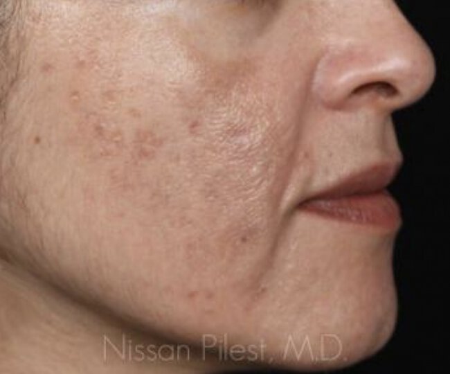 Pigmentation Before & After Image