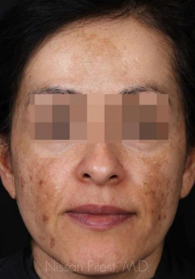 Pigmentation Before & After Image