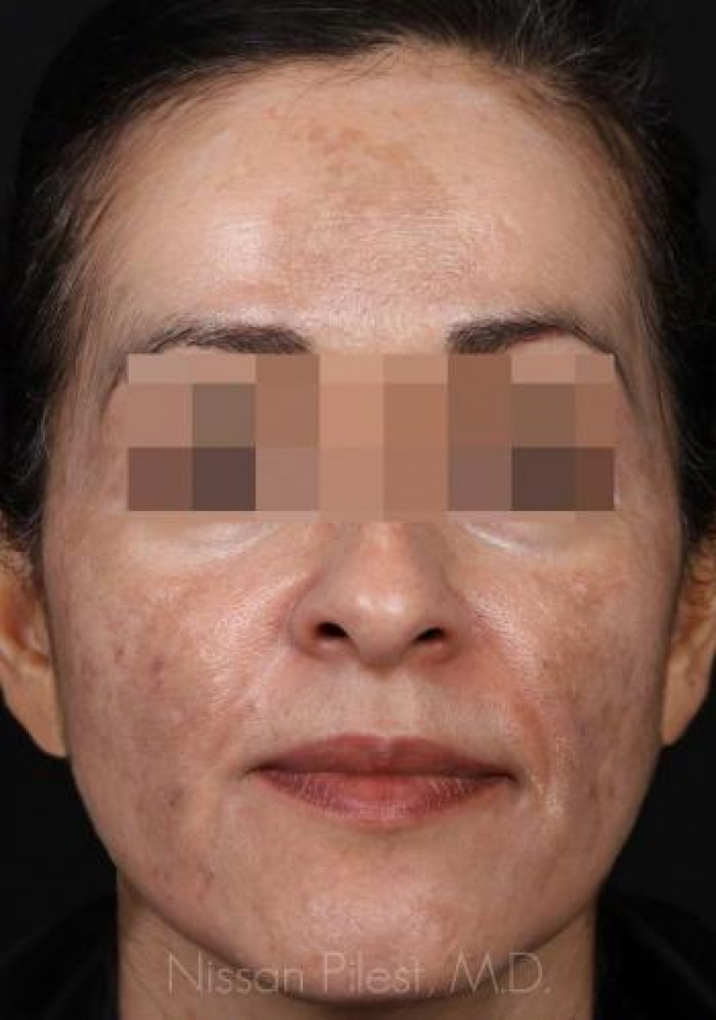 Pigmentation Before & After Image