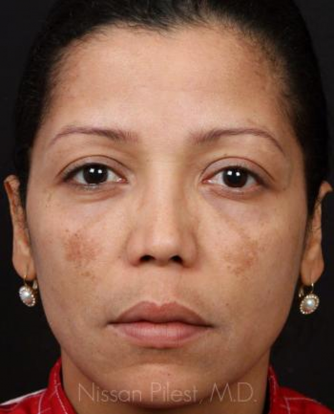 Pigmentation Before & After Image