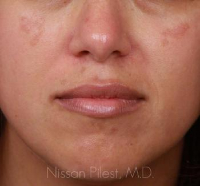 Pigmentation Before & After Image