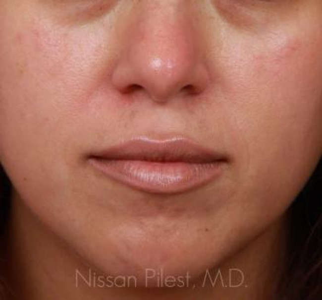 Pigmentation Before & After Image