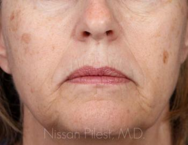 Pigmentation Before & After Image