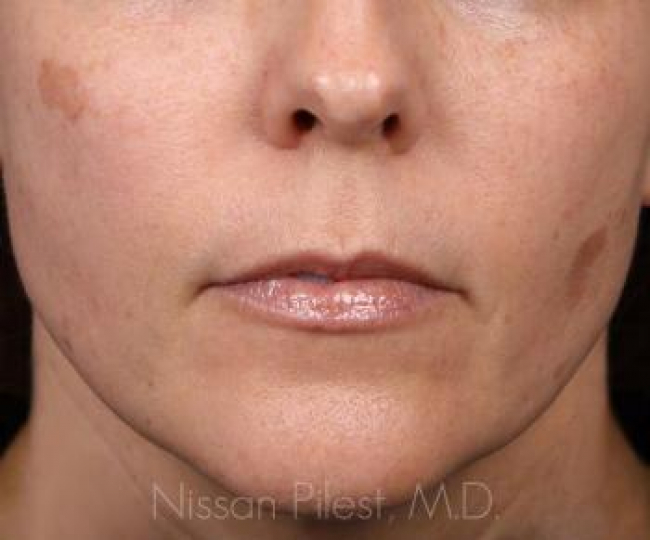 Pigmentation Before & After Image