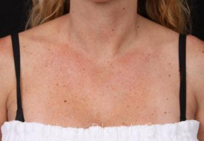 Pigmentation Before & After Image