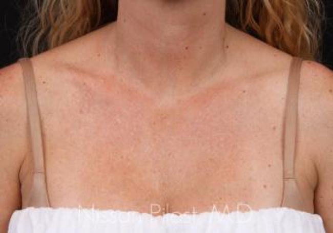 Pigmentation Before & After Image