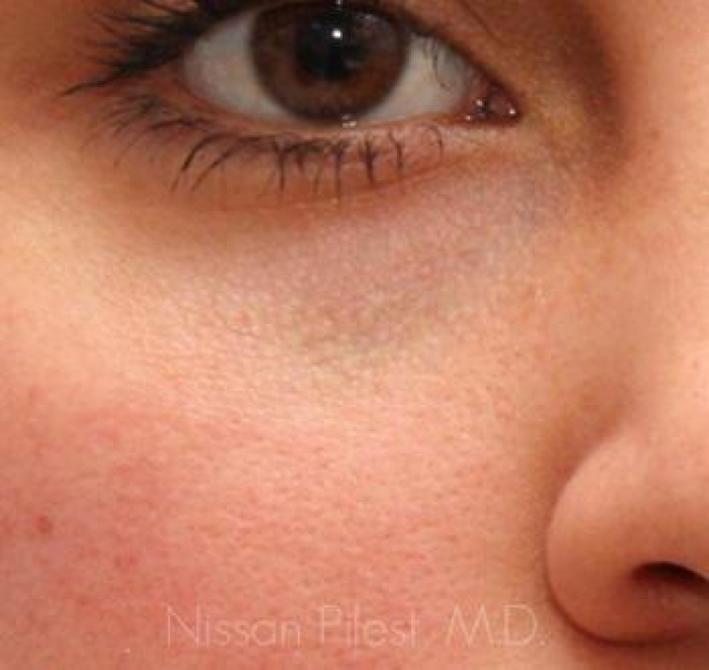 Pigmentation Before & After Image