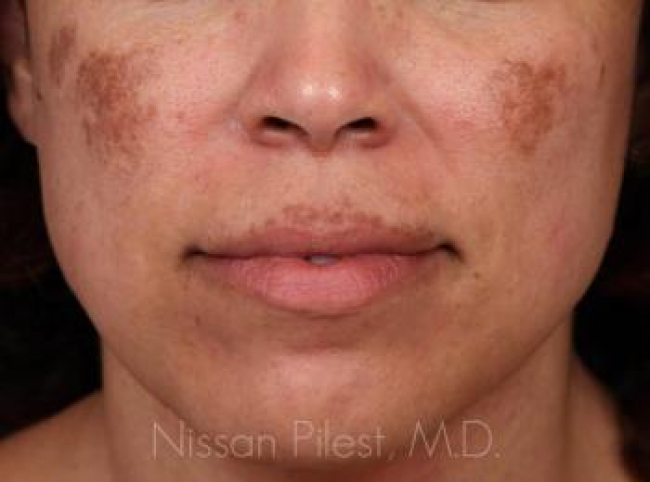 Pigmentation Before & After Image