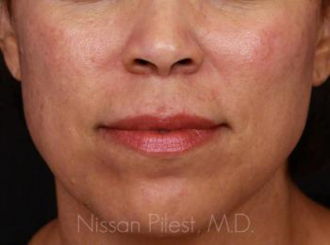 Pigmentation Before & After Image