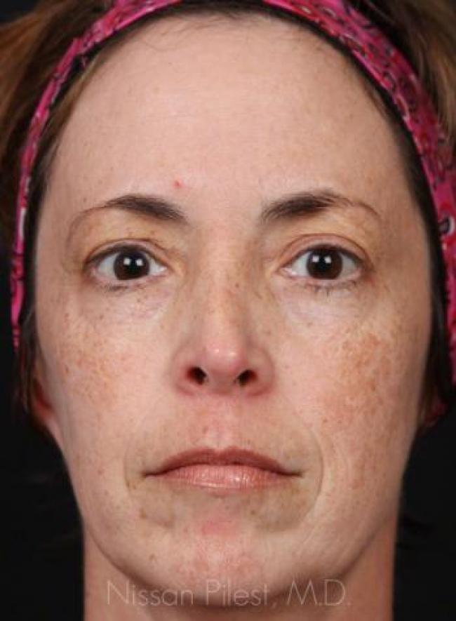 Pigmentation Before & After Image