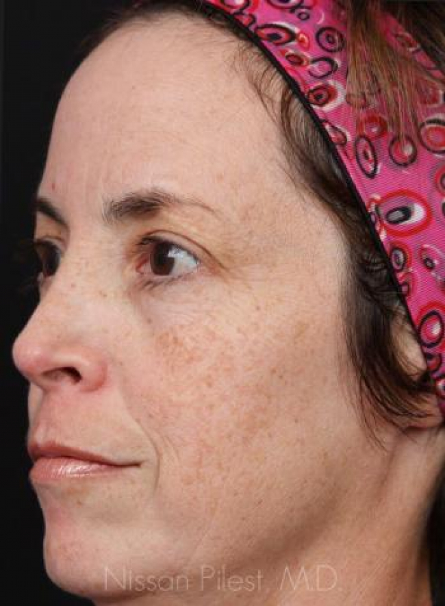 Pigmentation Before & After Image