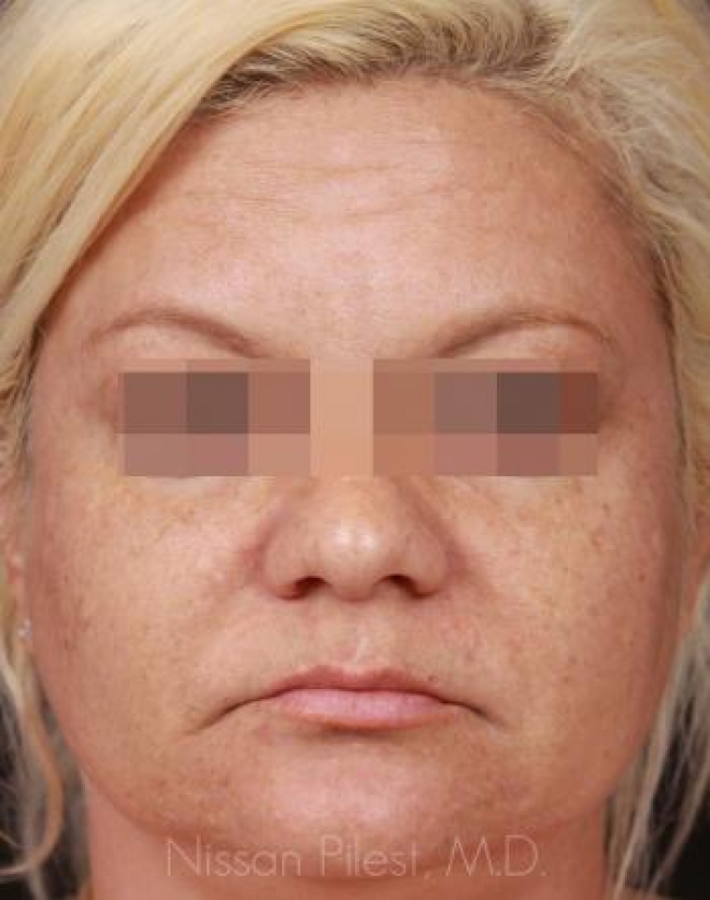 Pigmentation Before & After Image