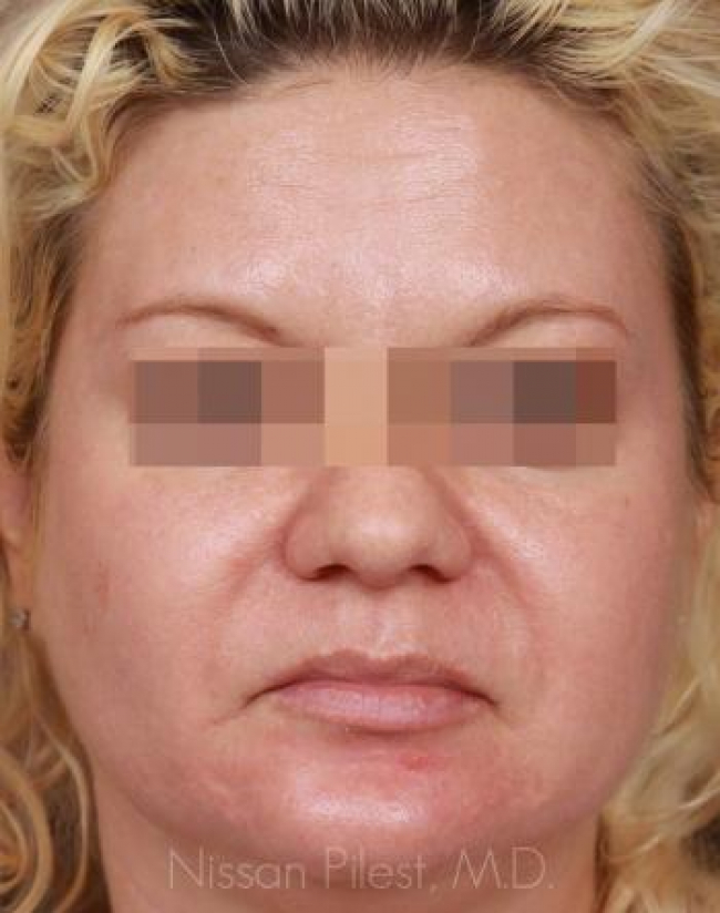 Pigmentation Before & After Image