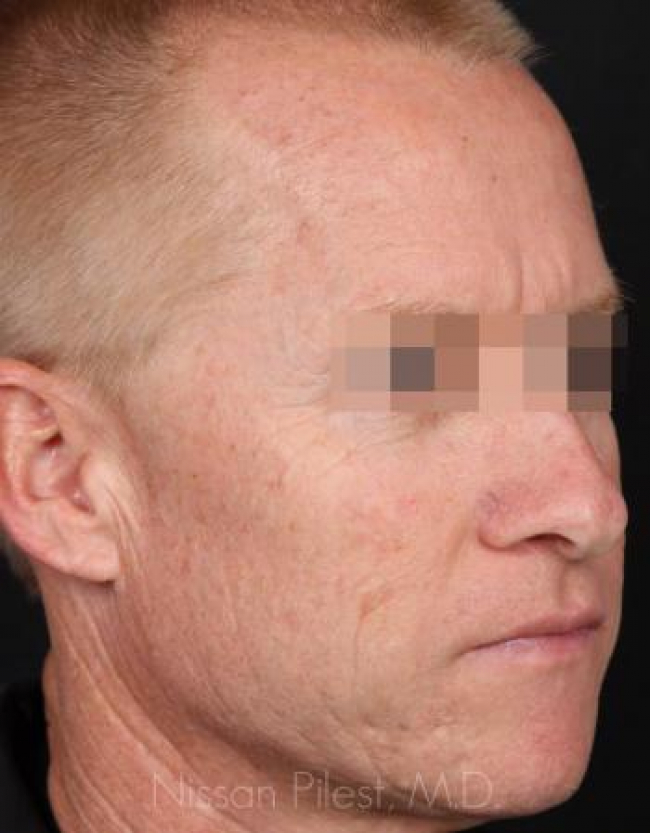 Pigmentation Before & After Image