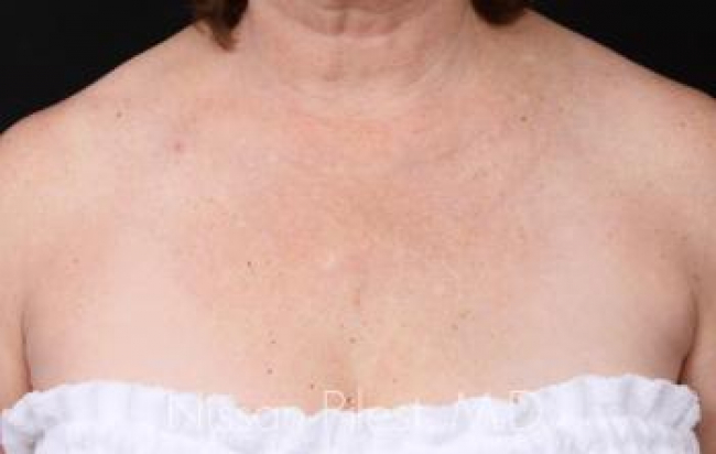 Pigmentation Before & After Image