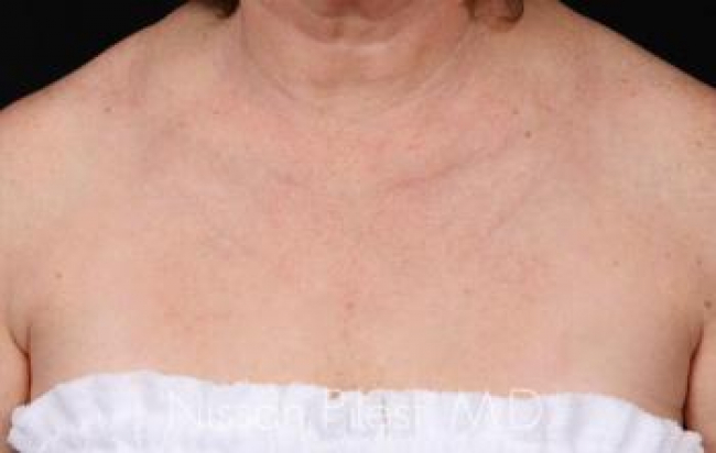 Pigmentation Before & After Image