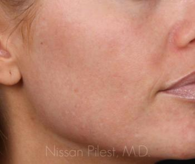 Pigmentation Before & After Image