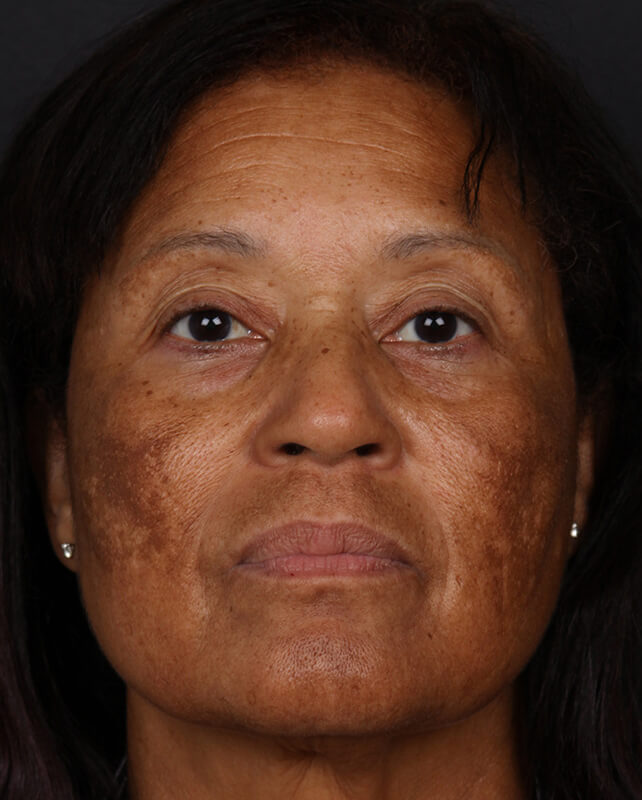 Pigmentation Before & After Image