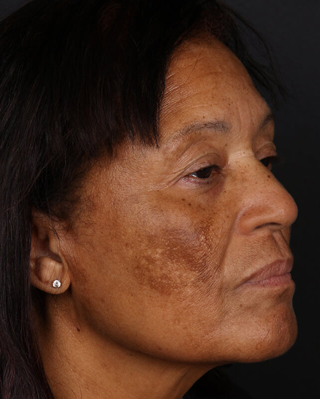 Pigmentation Before & After Image