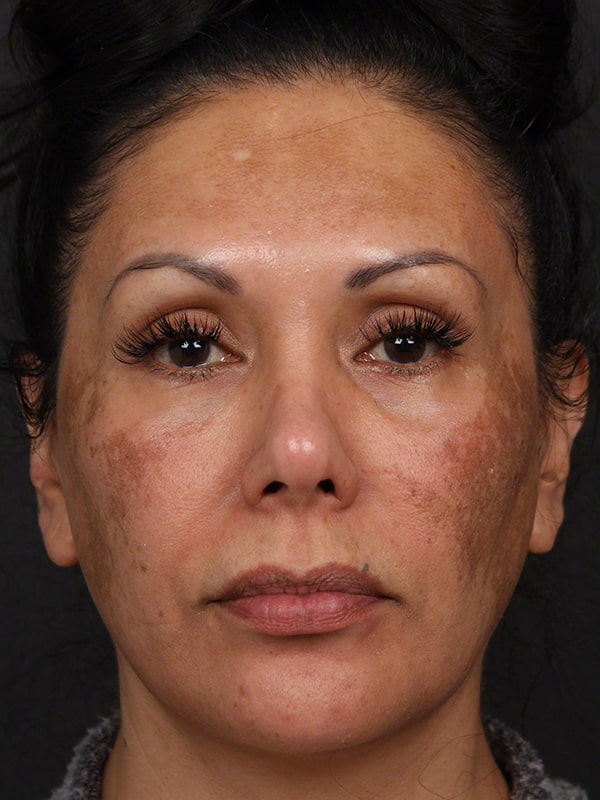 Pigmentation Before & After Image