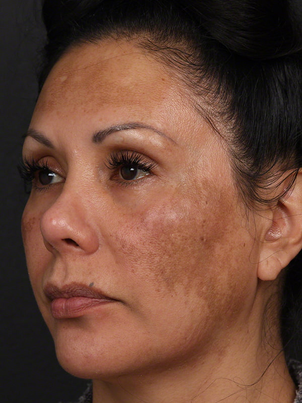 Pigmentation Before & After Image