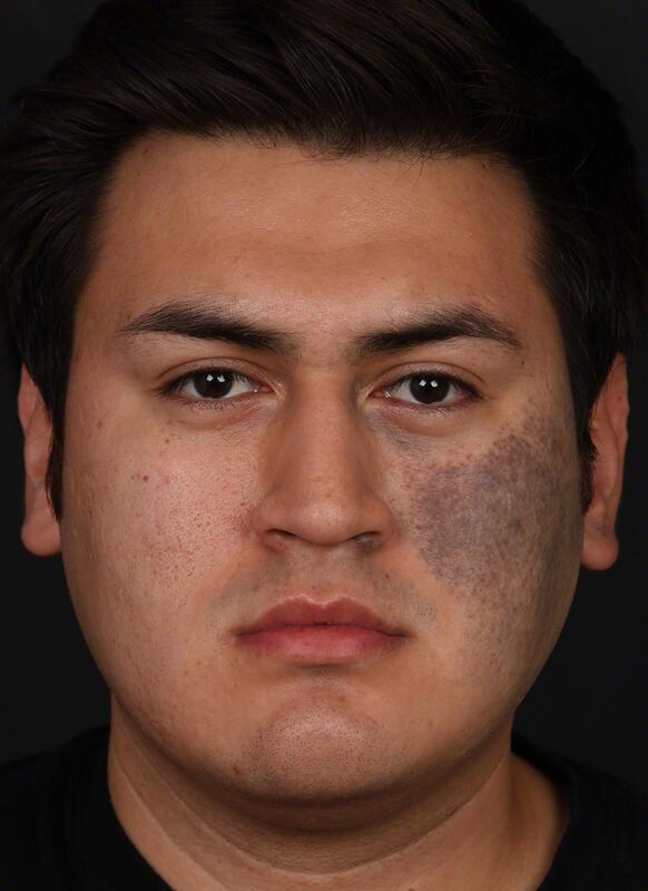 Pigmentation Before & After Image