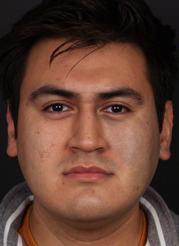 Pigmentation Before & After Image