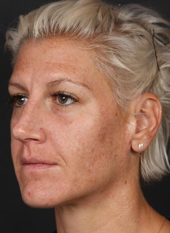 Pigmentation Before & After Image
