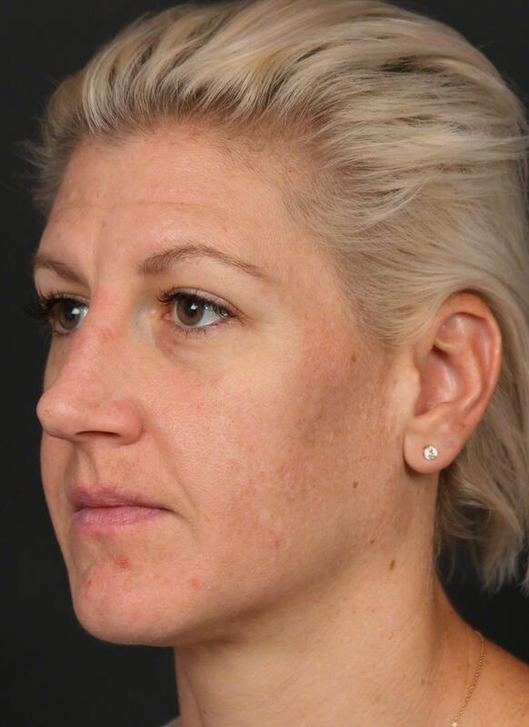 Pigmentation Before & After Image