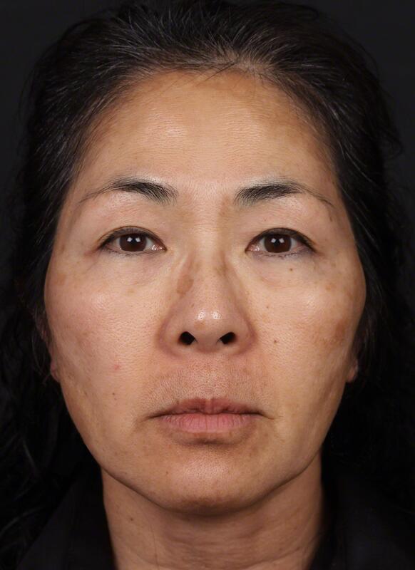 Pigmentation Before & After Image