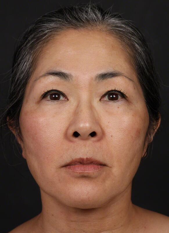 Pigmentation Before & After Image