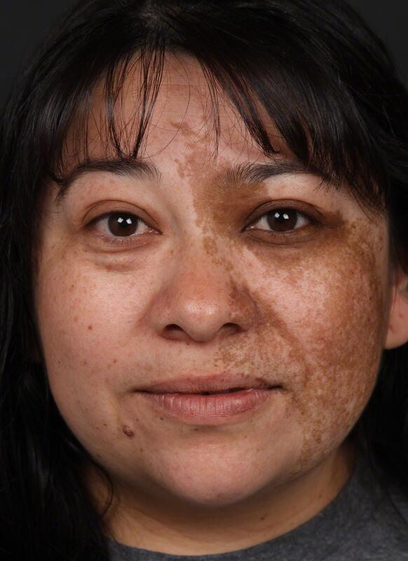 Pigmentation Before & After Image