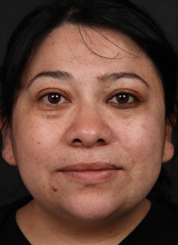 Pigmentation Before & After Image